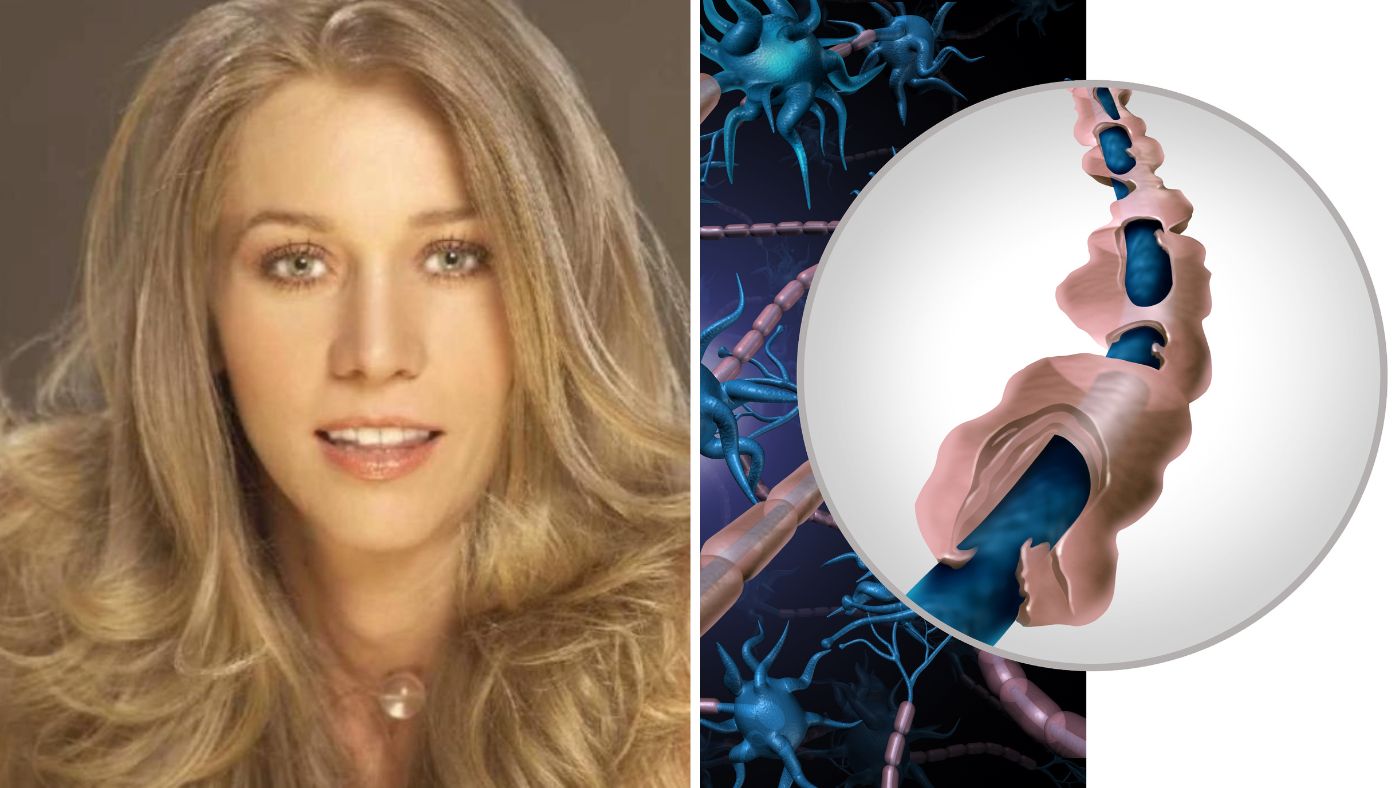 ¿Quién es Mónica Dossetti y qué es la esclerosis múltiple, la terrible enfermedad que padece?