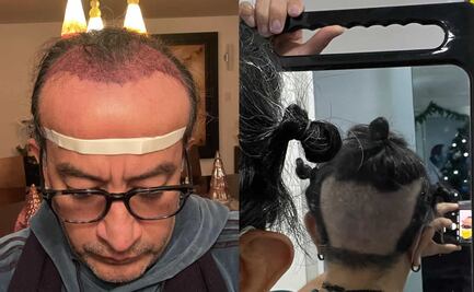 Así fue el injerto de cabello al que se sometió Germán Ortega