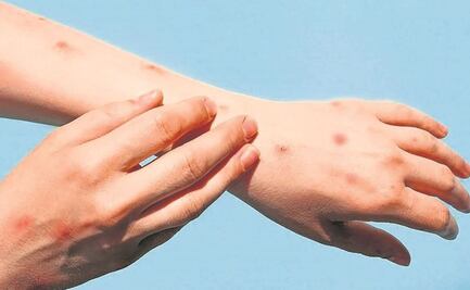 Llega a su fin la emergencia sanitaria por viruela símica, así se vivió en Puebla 