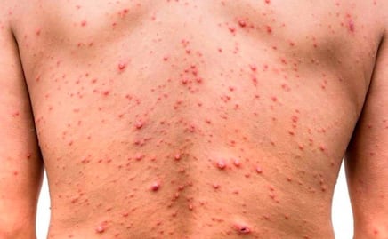 Secretaría de Salud descarta presencia de viruela símica en escuelas de Puebla