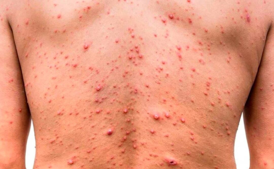 Actualmente, se tienen registrados 481 casos probables de coxsackie en escuelas del estado | Foto: Especial