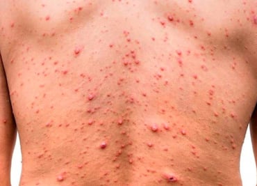 Secretaría de Salud descarta presencia de viruela símica en escuelas de Puebla