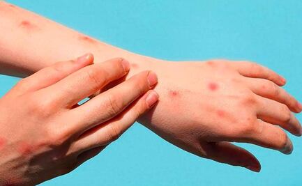 Viruela del mono: confirman primer caso en México