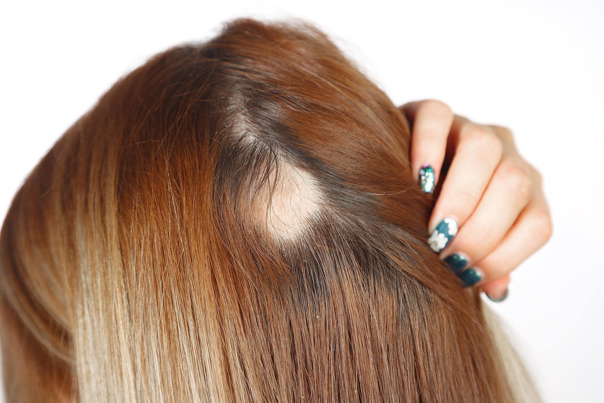 La alopecia, o pérdida de cabello, puede afectar solo el cuero cabelludo, el cuerpo entero, y puede ser temporal o permanente. 

Foto: Producción El Universal Puebla