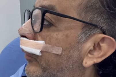 Germán Ortega de Los Mascabrothers se somete a cirugía estética de la nariz