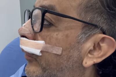 Germán Ortega de Los Mascabrothers se somete a cirugía estética de la nariz