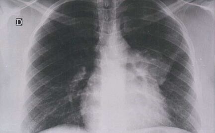 El de pulmón es el tipo de cáncer más mortal en Puebla