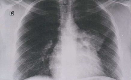 El de pulmón es el tipo de cáncer más mortal en Puebla