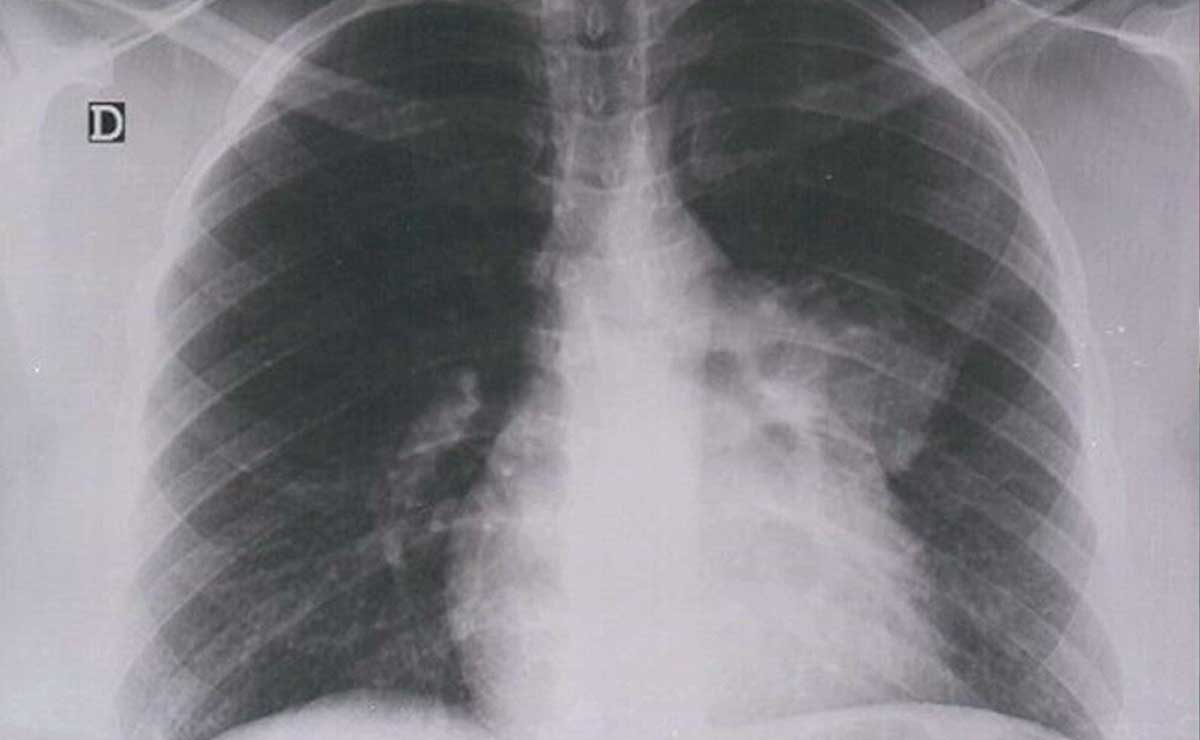 El de pulmón es el tipo de cáncer más mortal en Puebla