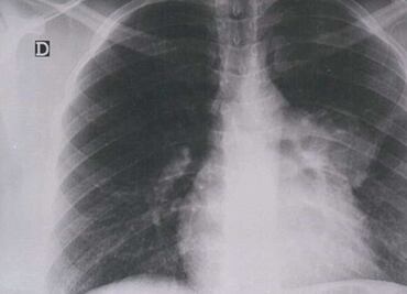 El de pulmón es el tipo de cáncer más mortal en Puebla