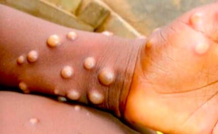 Suman 20 casos de viruela símica en Puebla: Salud