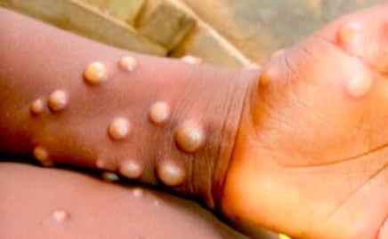 Suman 20 casos de viruela símica en Puebla: Salud