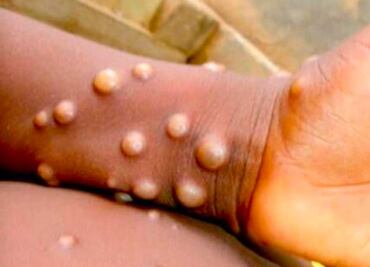 Suman 20 casos de viruela símica en Puebla: Salud