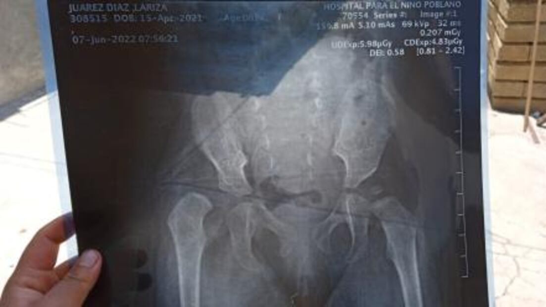 Acusan a Hospital para el Niño Poblano de retrasar más de un año cirugía de bebé