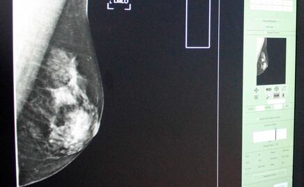 Ojo aquí: mejorar hábitos reduce riesgo de cáncer