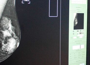 Ojo aquí: mejorar hábitos reduce riesgo de cáncer