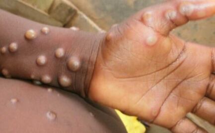 Suman 10 casos de viruela símica en Puebla
