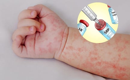 Sarampión: ¿Cuándo puede ser mortal? Estos son los signos de alarma