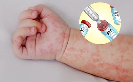 Sarampión: ¿Cuándo puede ser mortal? Estos son los signos de alarma
