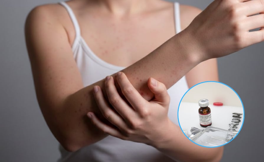 Crece rápido el sarampión en Puebla, ya van 16 casos confirmados