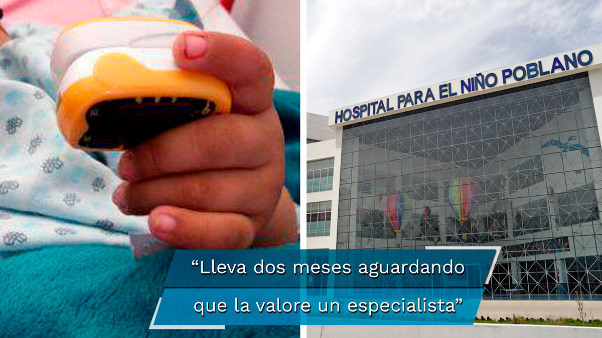 Alexa sigue esperando su tercera cirugía y solo hay un neurocirujano que no se da abasto