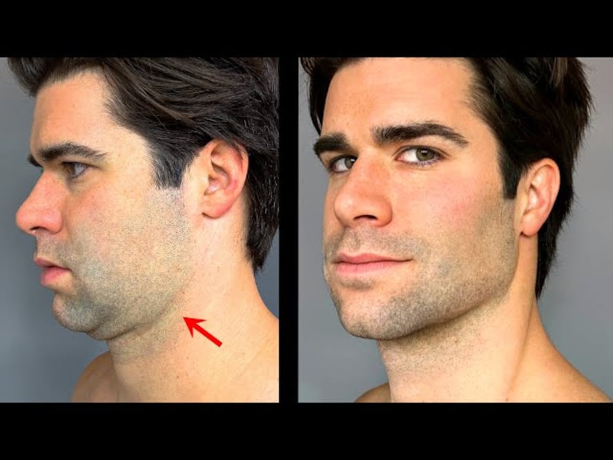 Hasta la fecha, no hay estudios científicos rigurosos que respalden la efectividad de la técnica del mewing para modificar la forma de la mandíbula. 

Foto: Producción El Universal Puebla