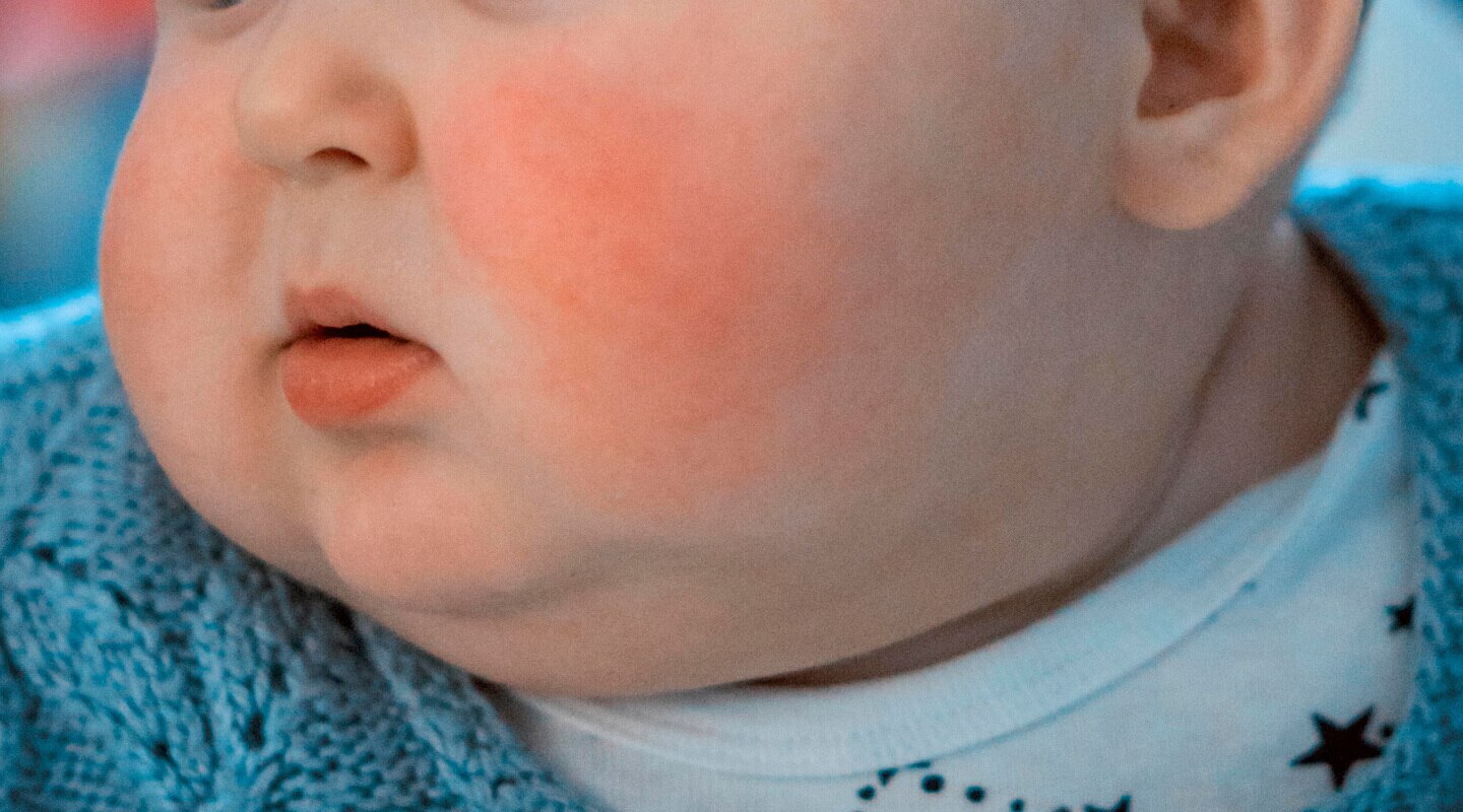 Los síntomas del virus de la bofetada, o eritema infeccioso, pueden variar según la etapa de la enfermedad y la persona afectada. 
Foto: Producción El Universal Puebla