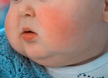 Virus de la bofetada: la nueva y curiosa enfermedad que preocupa a Europa