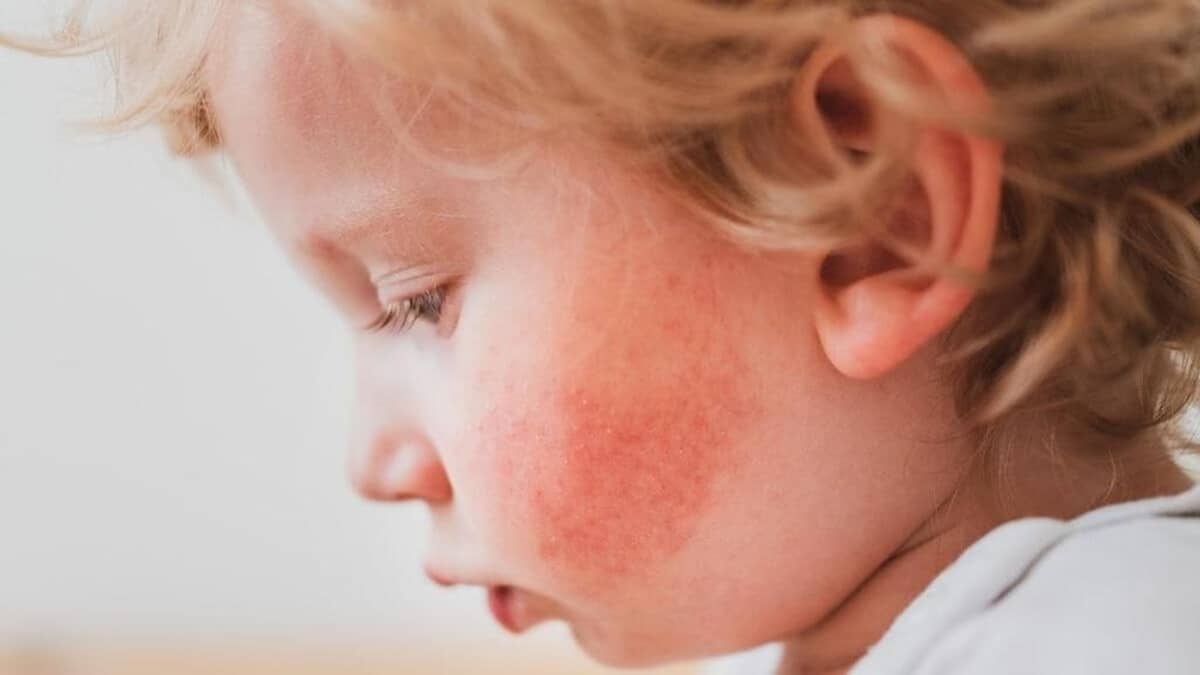 Esta enfermedad es más común en niños y suele causar síntomas leves, como fiebre baja, malestar general y, ocasionalmente, dolores en las articulaciones. 

Foto: Producción El Universal Puebla