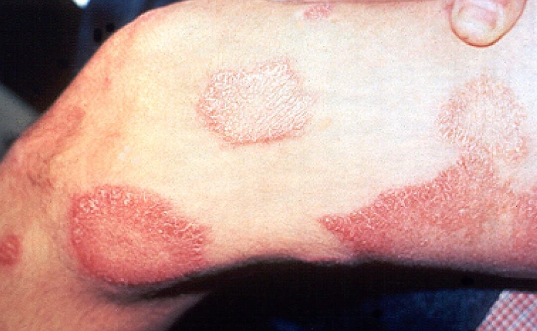 Puebla acumuló 4 casos de lepra en 2022 y todos fueron en mujeres | Imagen: redes sociales